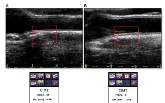 颈动脉三维仿真超声重建系统vCarotid