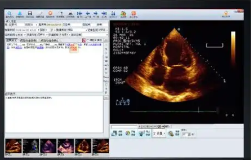 SYY-Breast US Workstation V1乳腺超声工作站软件