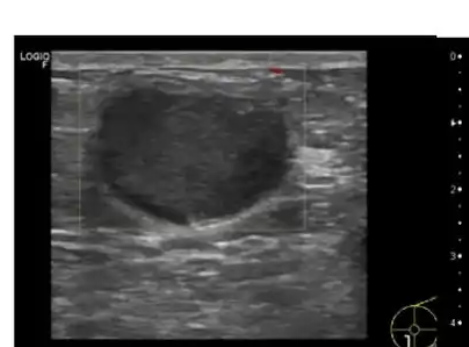SonoBreast乳腺超声图像分析软件