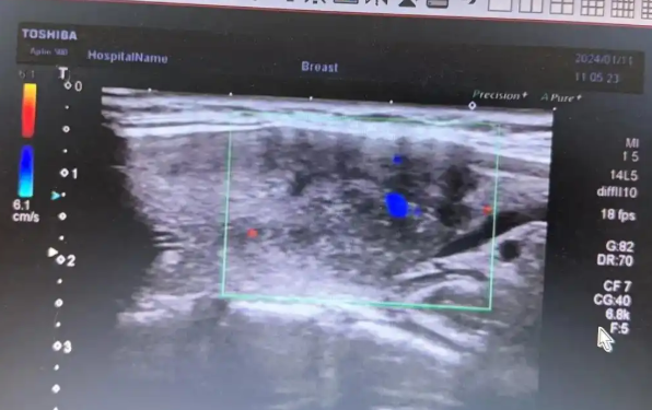 SW-TH01/II甲状腺超声图像分析软件