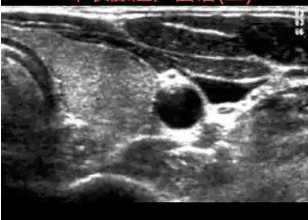 QX-USAI甲状腺超声影像分析软件