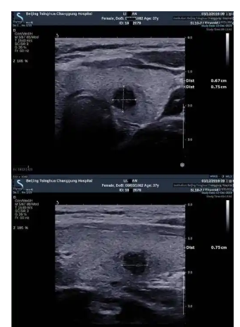 IQS001甲状腺乳腺超声影像管理软件