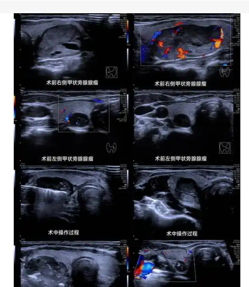 USCAD-TH甲状腺超声图像处理软件